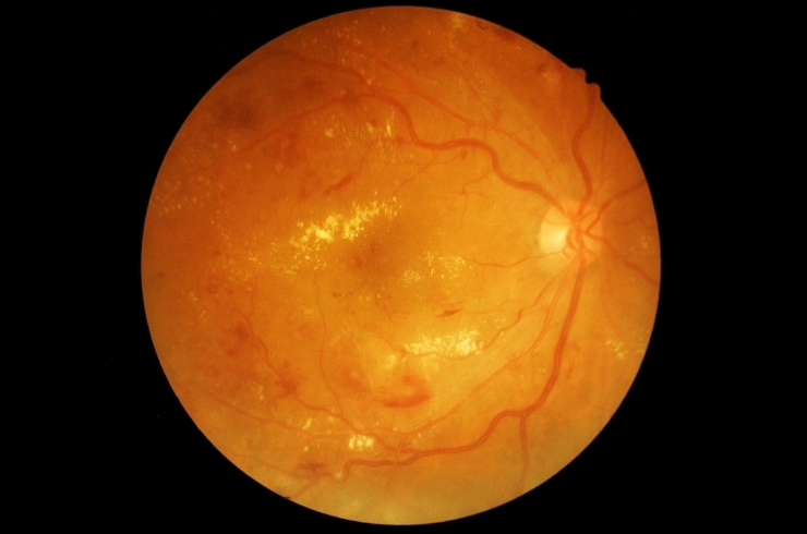 Retina image showing diabetic eye disease changes for diagnosis and treatment