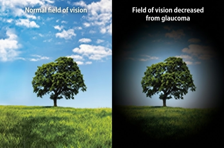 Comparison of normal vision and glaucoma vision loss showing reduced field of vision