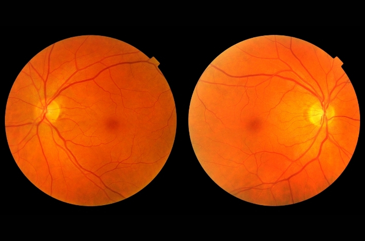 Retina fundus image for eye diagnosis in Thane hospital