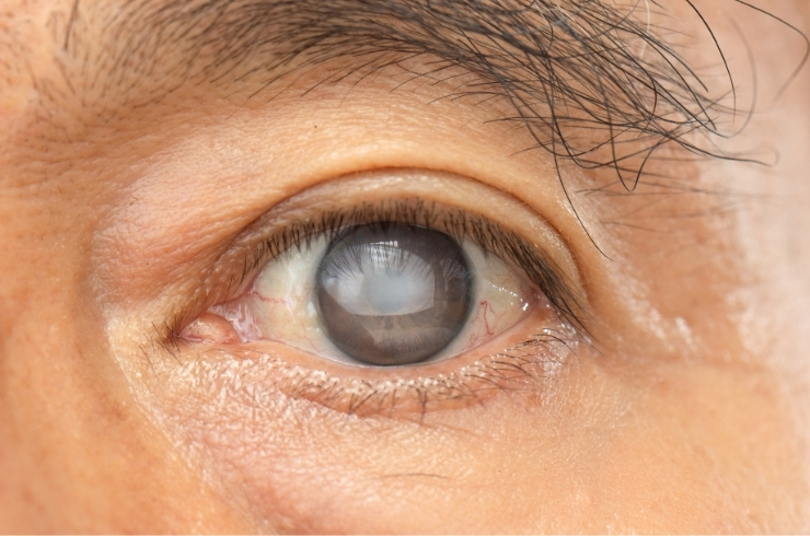 Cataract affected eye showing cloudy lens for diagnosis and treatment